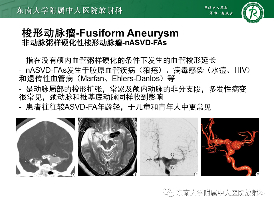 影像PPT - 【PPT】颅内动脉瘤-23