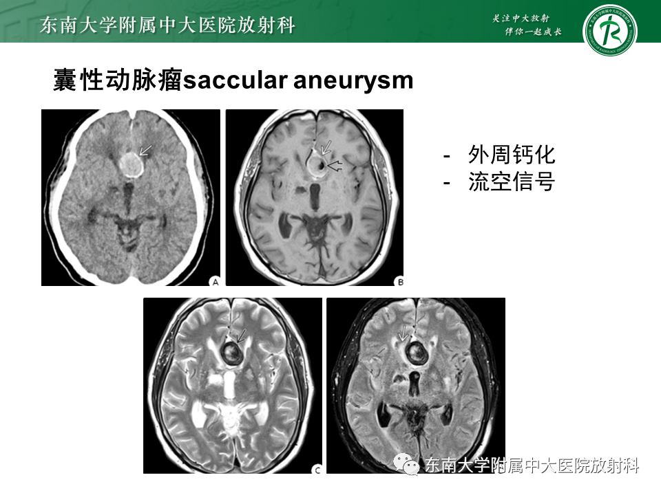 影像PPT - 【PPT】颅内动脉瘤-18