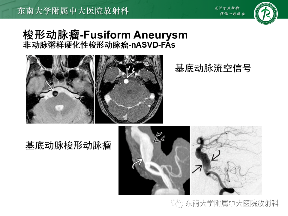 影像PPT - 【PPT】颅内动脉瘤-24