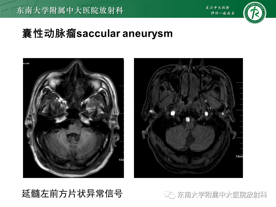 影像PPT - 【PPT】颅内动脉瘤-20