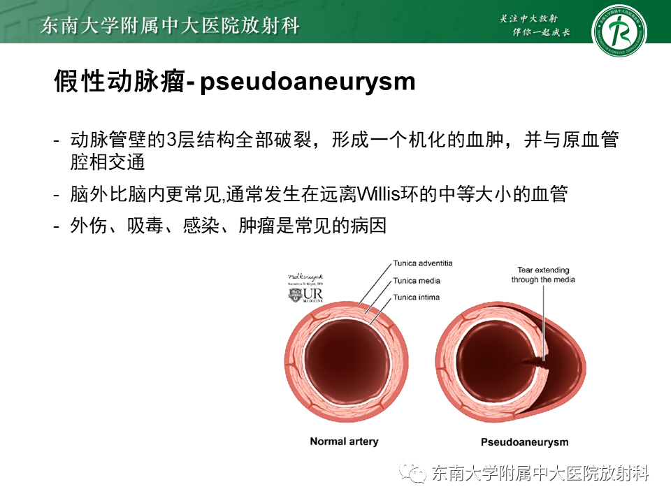 影像PPT - 【PPT】颅内动脉瘤-28