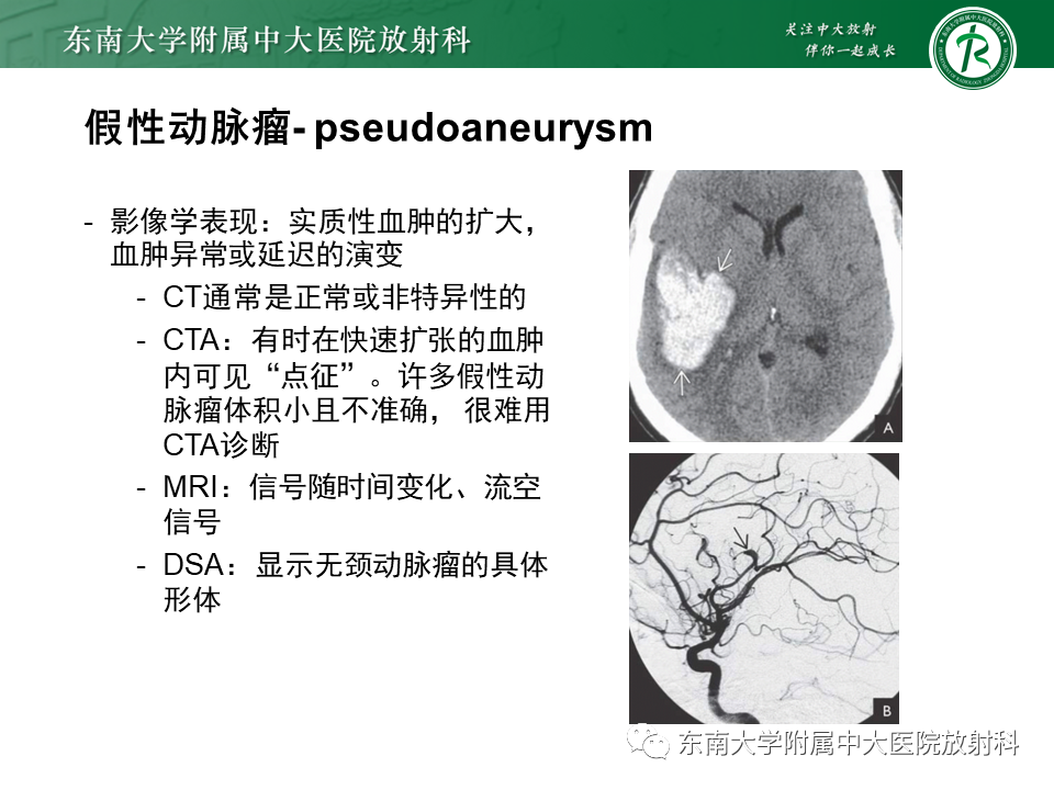 影像PPT - 【PPT】颅内动脉瘤-29