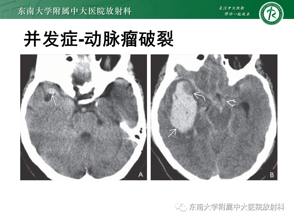 影像PPT - 【PPT】颅内动脉瘤-33