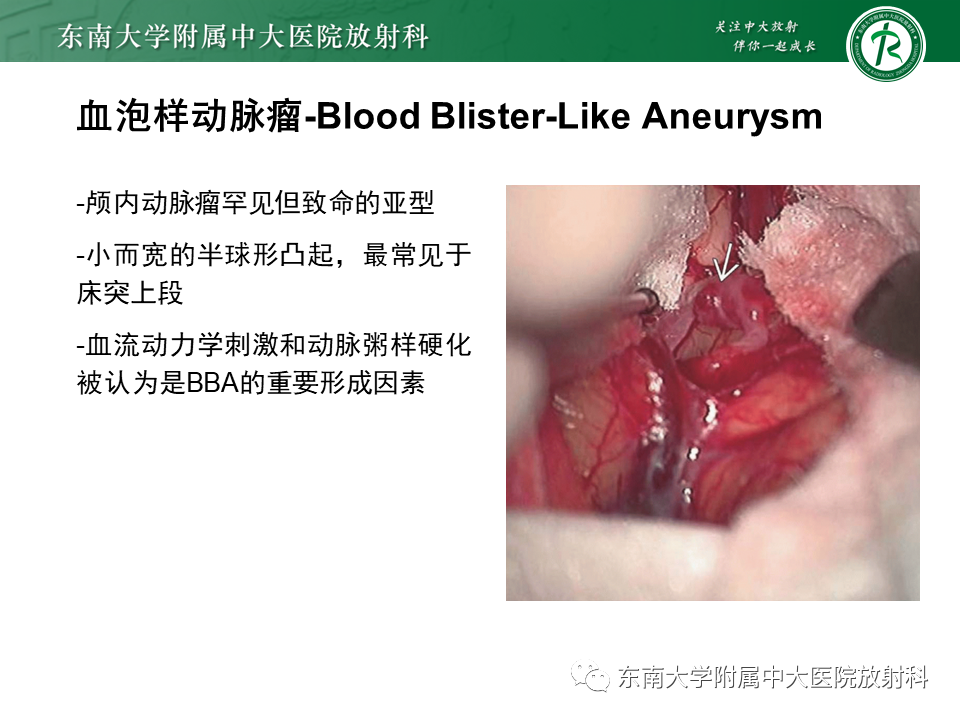 影像PPT - 【PPT】颅内动脉瘤-26