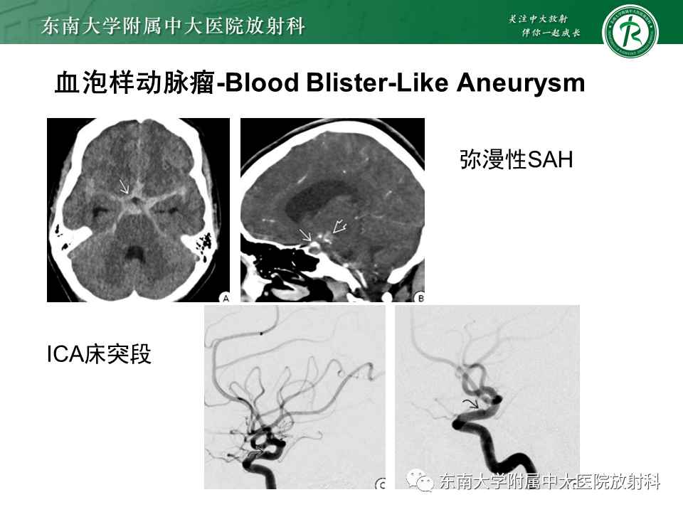 影像PPT - 【PPT】颅内动脉瘤-27