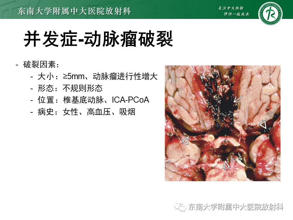 影像PPT - 【PPT】颅内动脉瘤-31