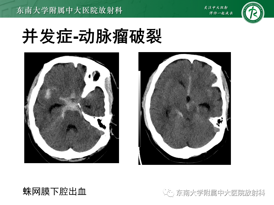 影像PPT - 【PPT】颅内动脉瘤-32