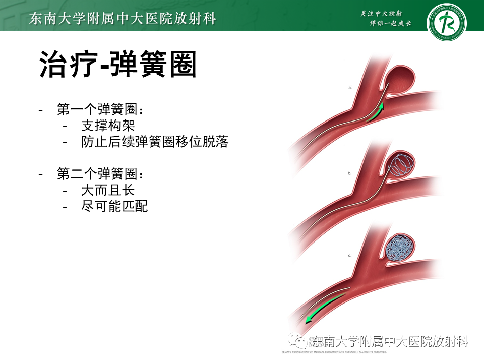 影像PPT - 【PPT】颅内动脉瘤-36