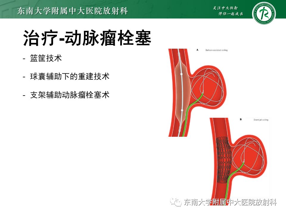 影像PPT - 【PPT】颅内动脉瘤-37