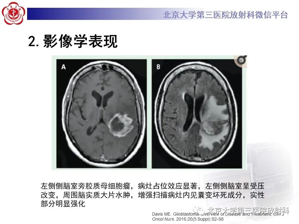 影像PPT - 【PPT】胶质母细胞瘤-13