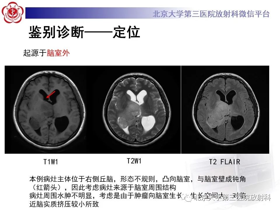 影像PPT - 【PPT】胶质母细胞瘤-16