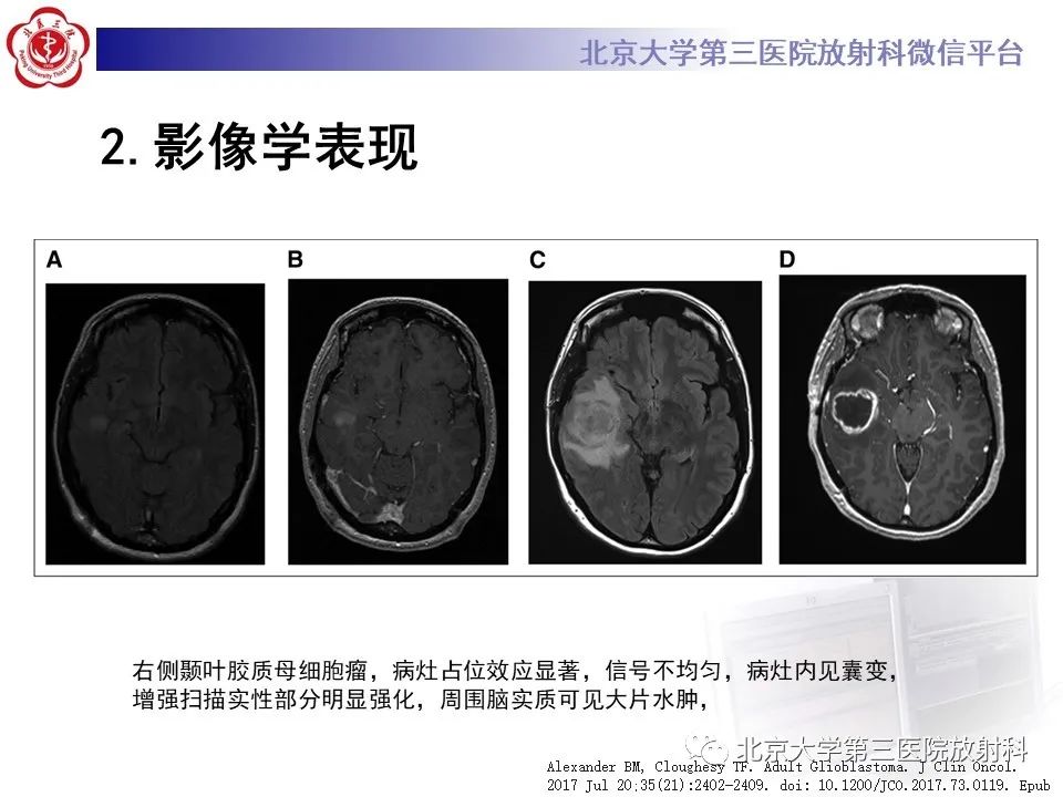 影像PPT - 【PPT】胶质母细胞瘤-12