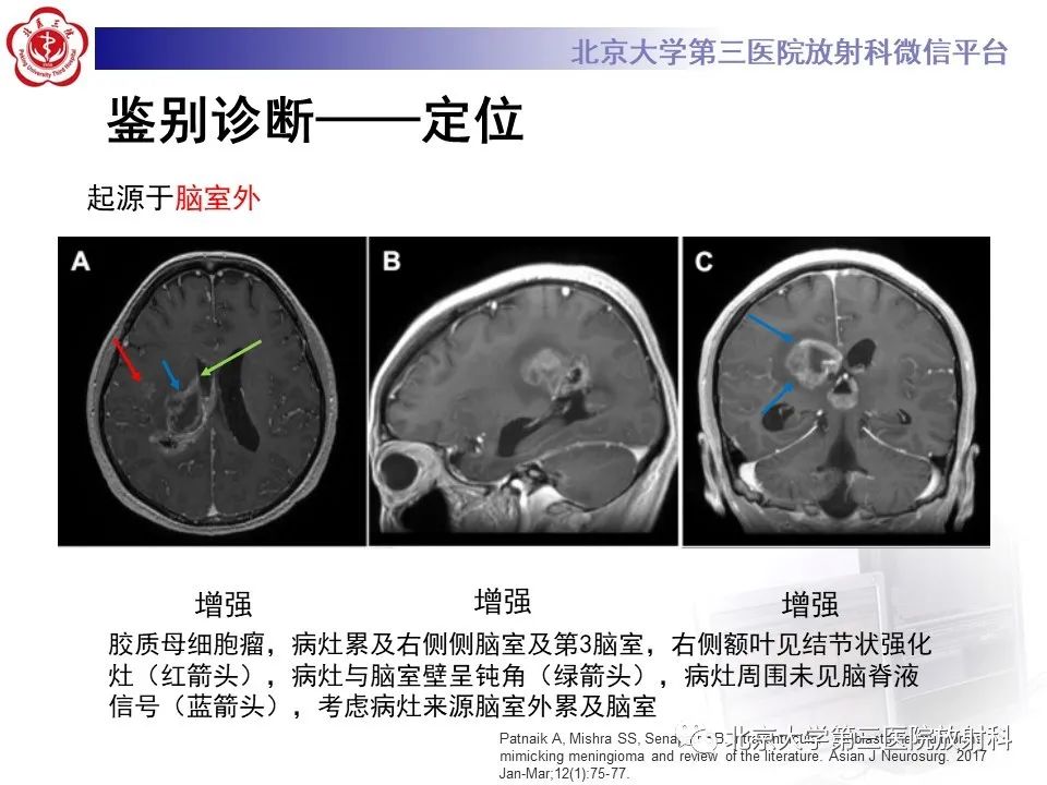 影像PPT - 【PPT】胶质母细胞瘤-18