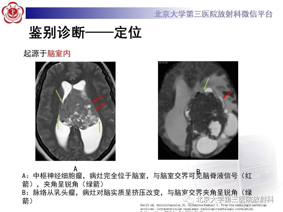 影像PPT - 【PPT】胶质母细胞瘤-19