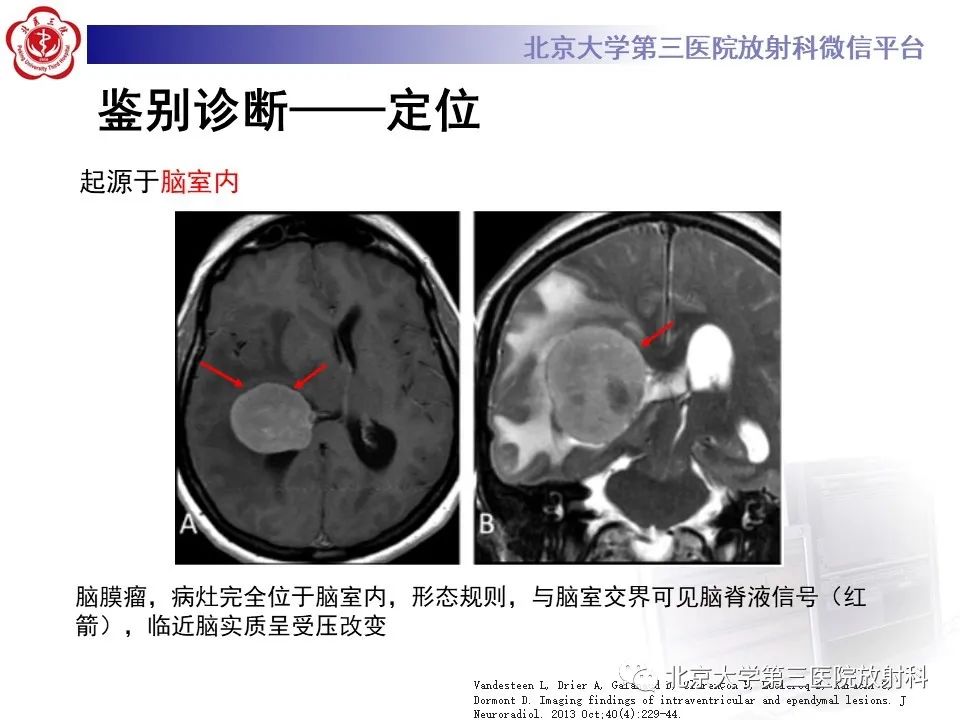 影像PPT - 【PPT】胶质母细胞瘤-20