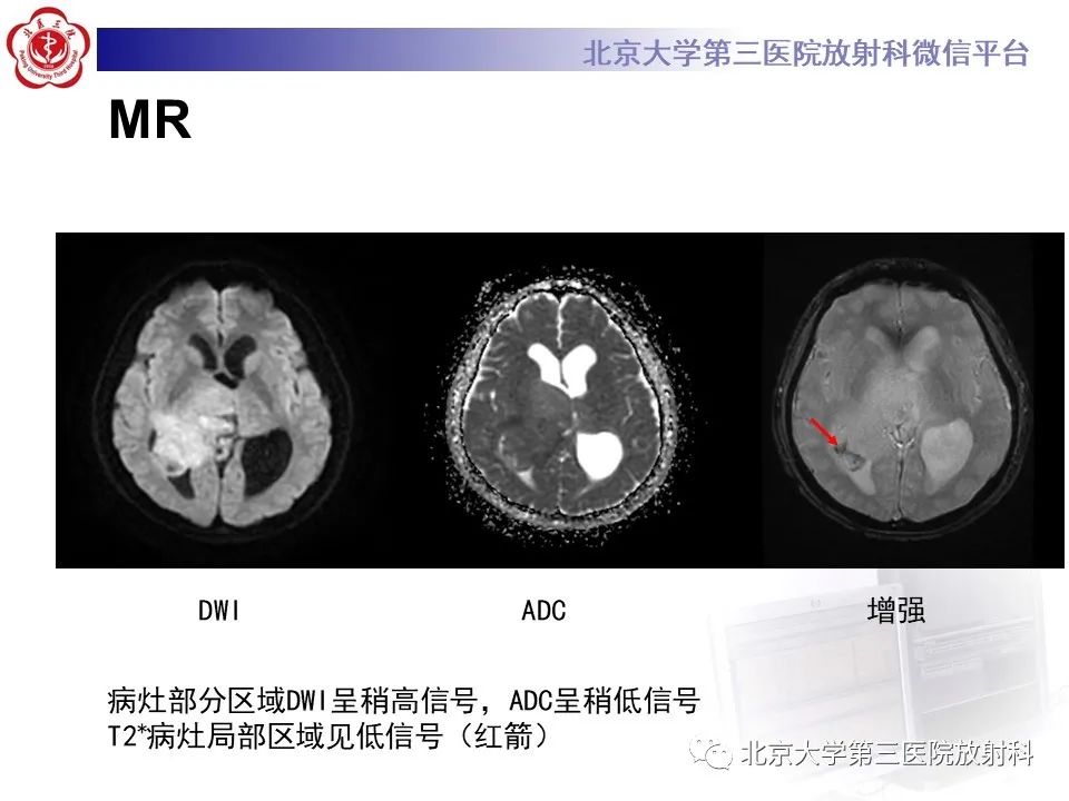 影像PPT - 【PPT】胶质母细胞瘤-4