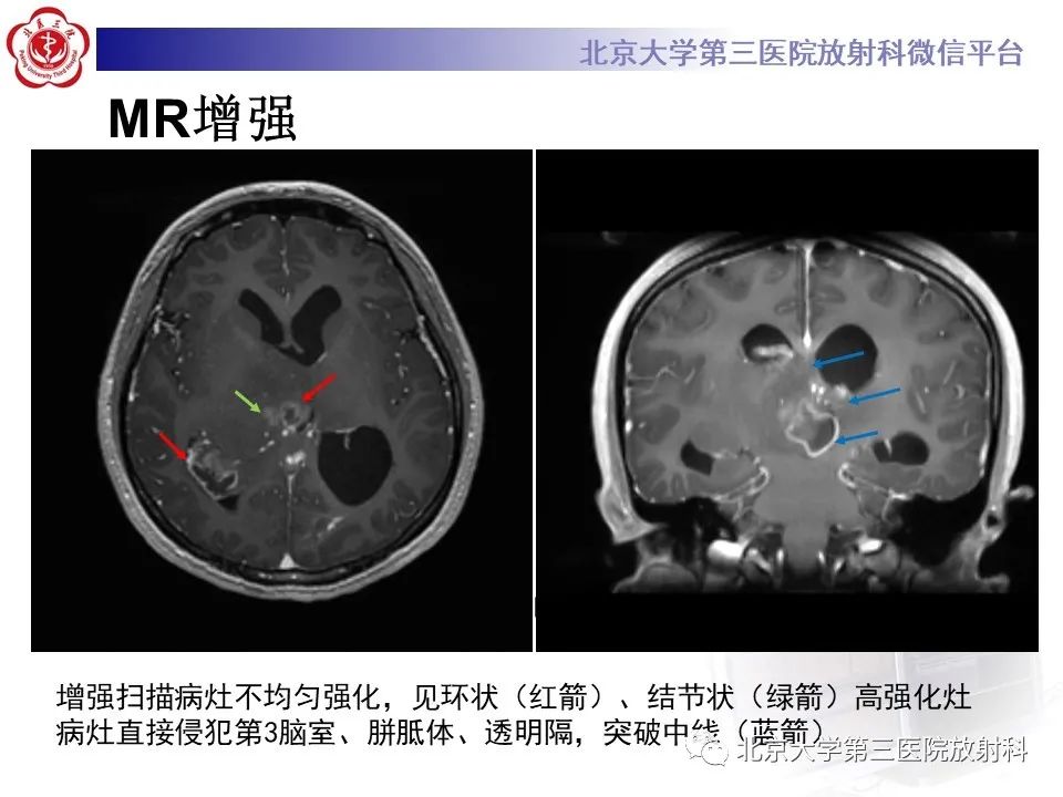 影像PPT - 【PPT】胶质母细胞瘤-5