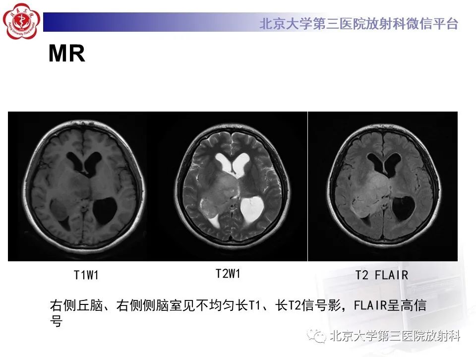 影像PPT - 【PPT】胶质母细胞瘤-3