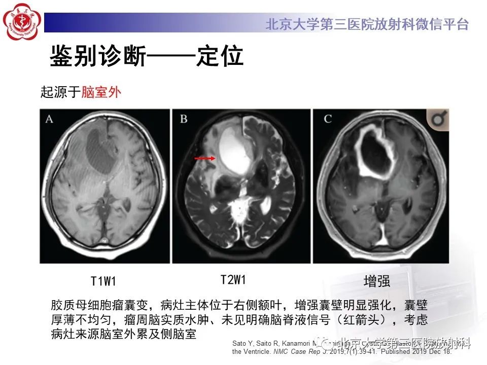 影像PPT - 【PPT】胶质母细胞瘤-17