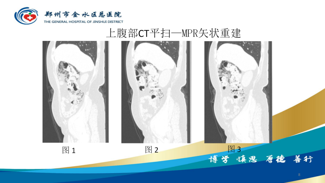 影像PPT - 【病例】肠壁囊样积气症-8