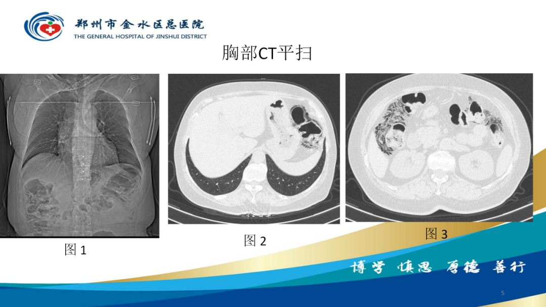 影像PPT - 【病例】肠壁囊样积气症-5
