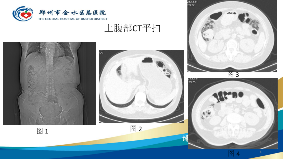 影像PPT - 【病例】肠壁囊样积气症-6