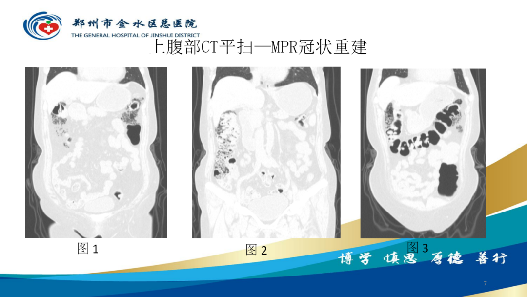 影像PPT - 【病例】肠壁囊样积气症-7