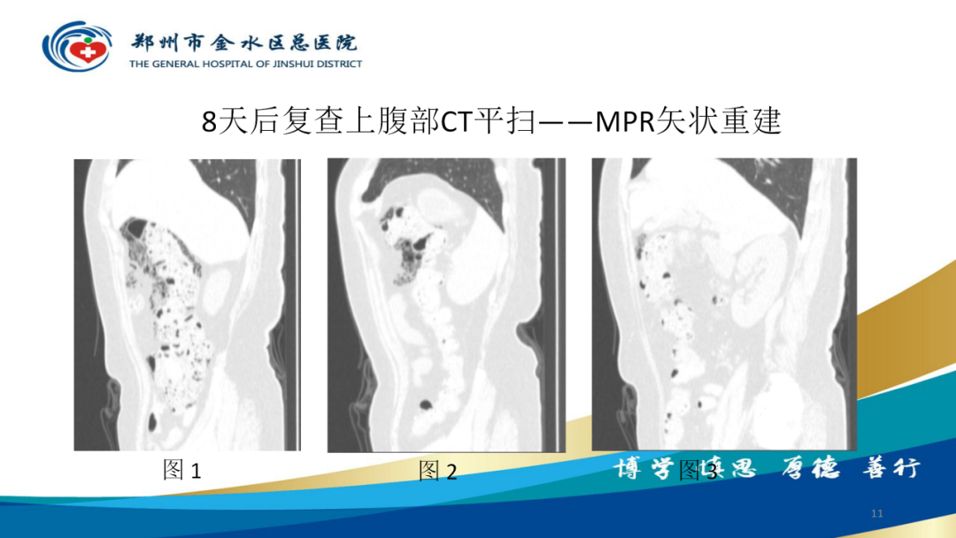 影像PPT - 【病例】肠壁囊样积气症-11