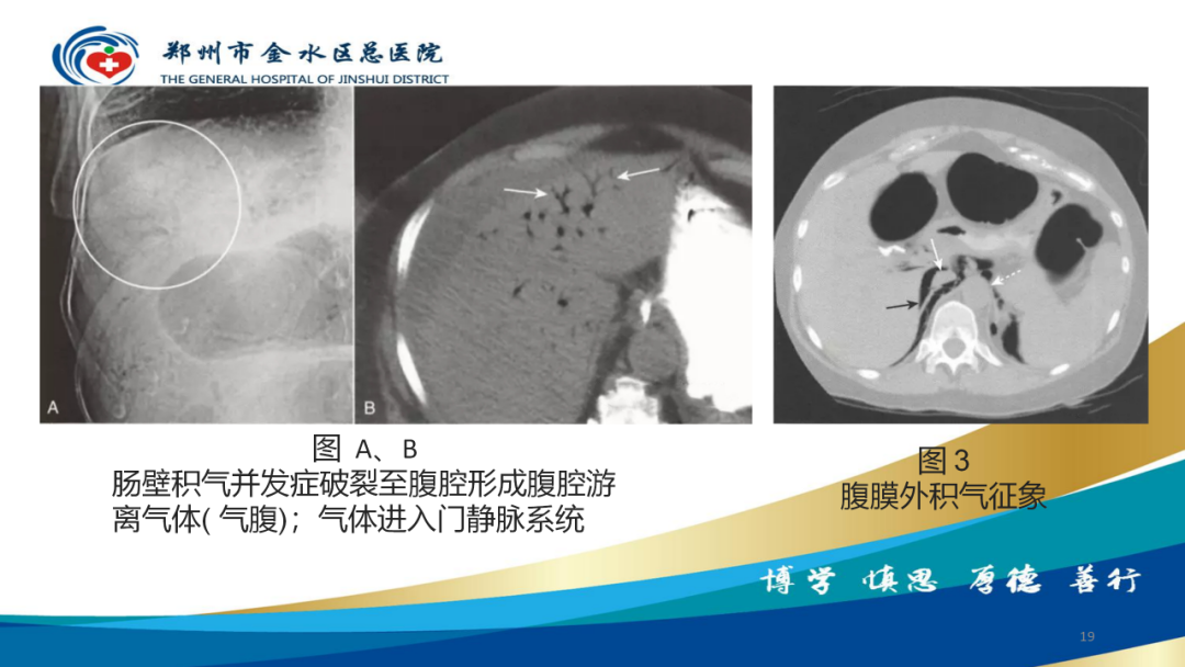 影像PPT - 【病例】肠壁囊样积气症-19