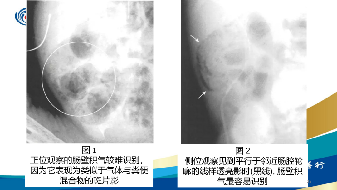 影像PPT - 【病例】肠壁囊样积气症-25