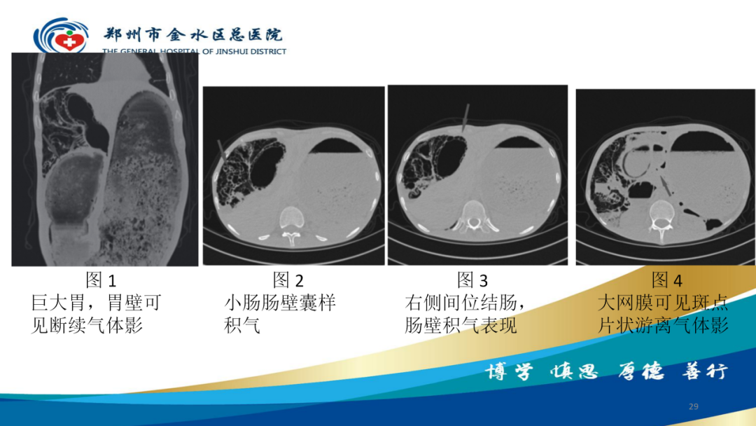 影像PPT - 【病例】肠壁囊样积气症-29