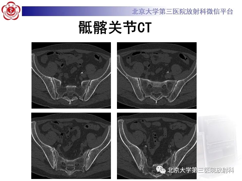 影像PPT - 【PPT】SAPHO综合征-5
