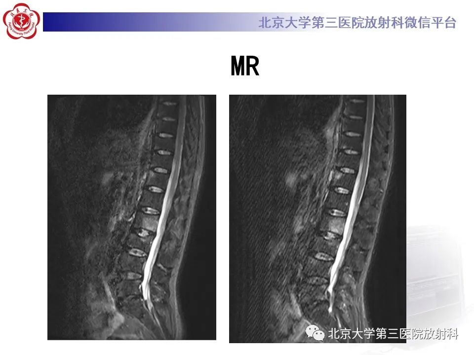 影像PPT - 【PPT】SAPHO综合征-8
