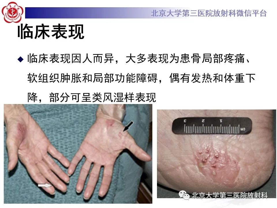 影像PPT - 【PPT】SAPHO综合征-15