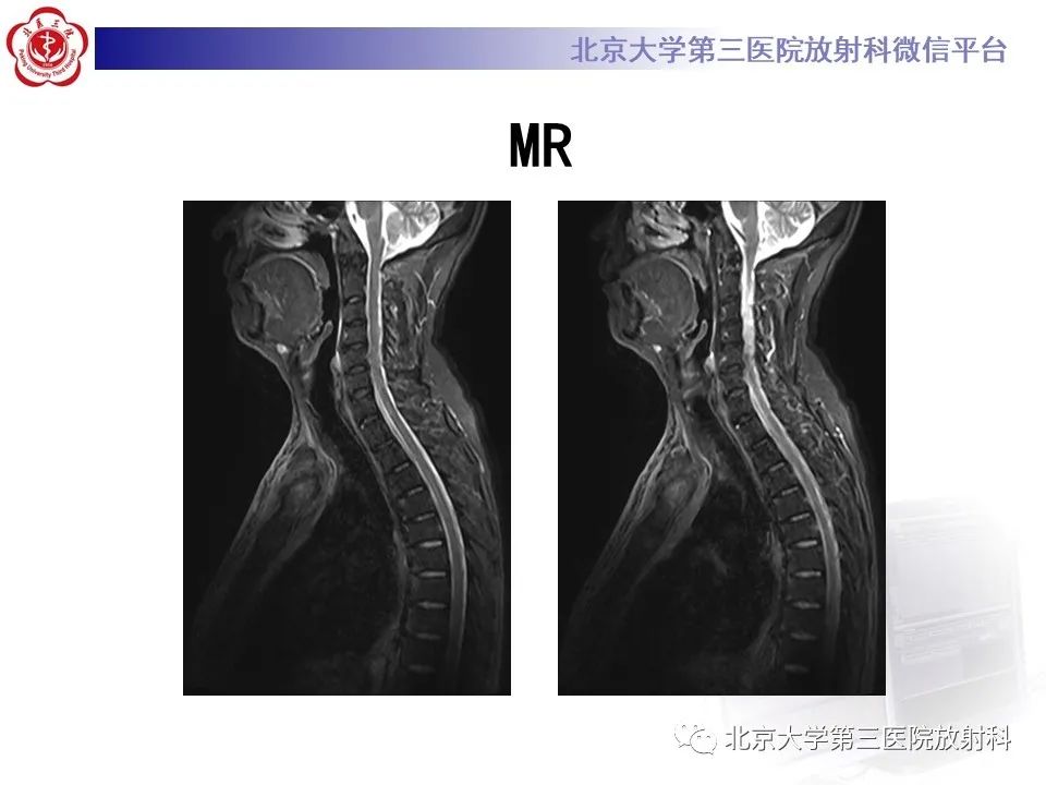影像PPT - 【PPT】SAPHO综合征-7