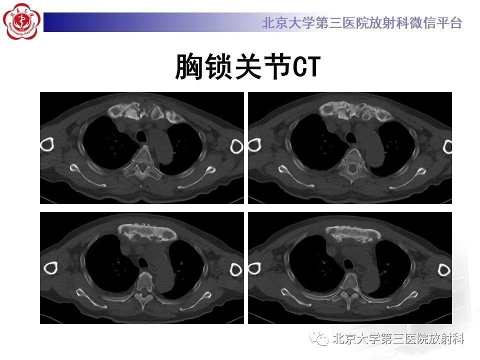影像PPT - 【PPT】SAPHO综合征-3
