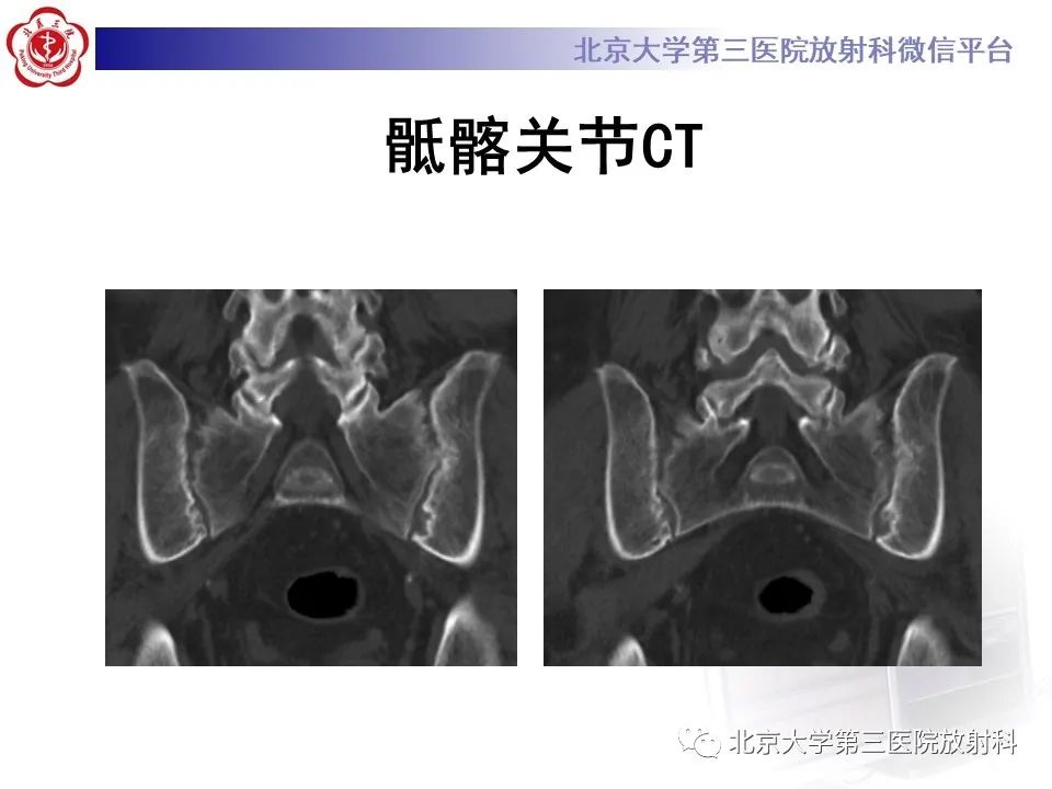 影像PPT - 【PPT】SAPHO综合征-6