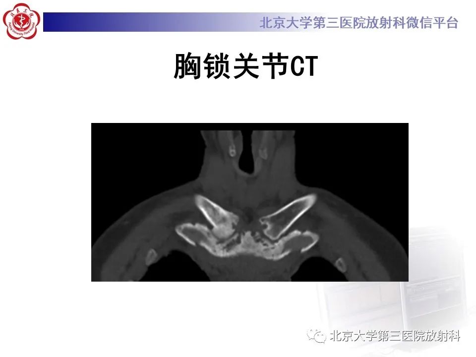 影像PPT - 【PPT】SAPHO综合征-4