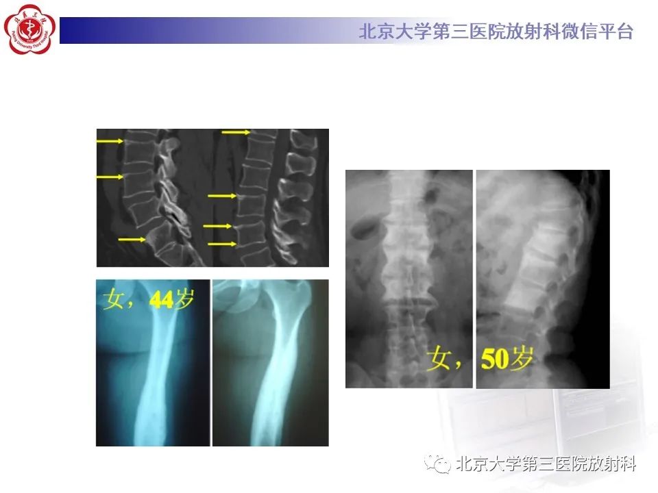 影像PPT - 【PPT】SAPHO综合征-21