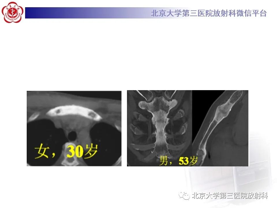 影像PPT - 【PPT】SAPHO综合征-22