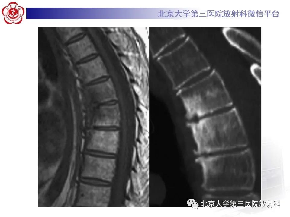 影像PPT - 【PPT】SAPHO综合征-23