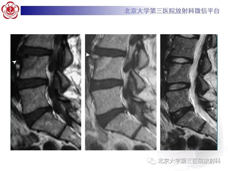影像PPT - 【PPT】SAPHO综合征-24