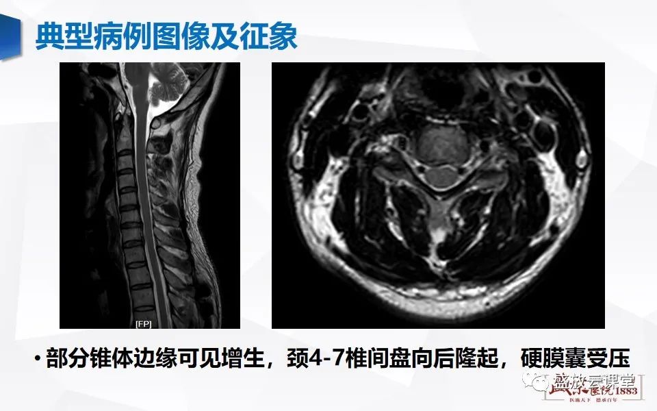 影像PPT - 【PPT】视神经脊髓炎谱系病变-5