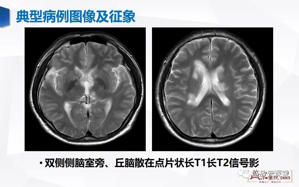 影像PPT - 【PPT】视神经脊髓炎谱系病变-4