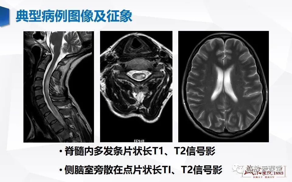 影像PPT - 【PPT】视神经脊髓炎谱系病变-11