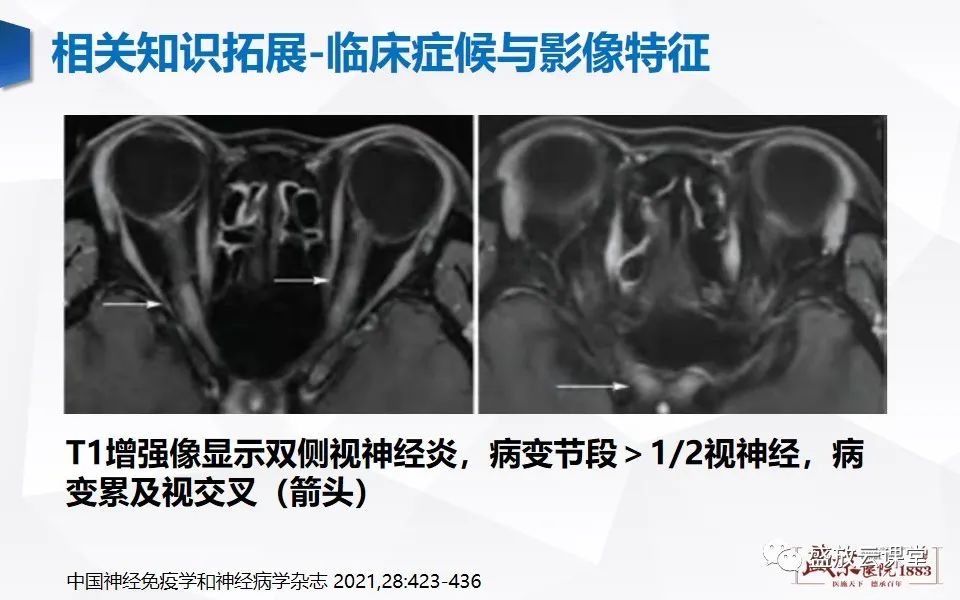 影像PPT - 【PPT】视神经脊髓炎谱系病变-22