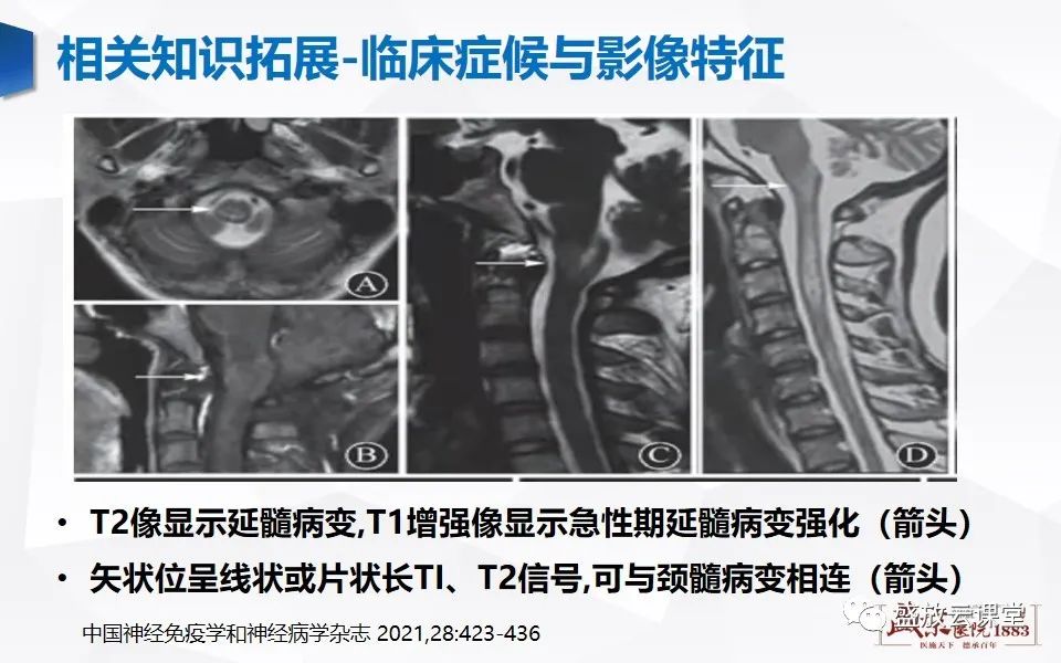 影像PPT - 【PPT】视神经脊髓炎谱系病变-27