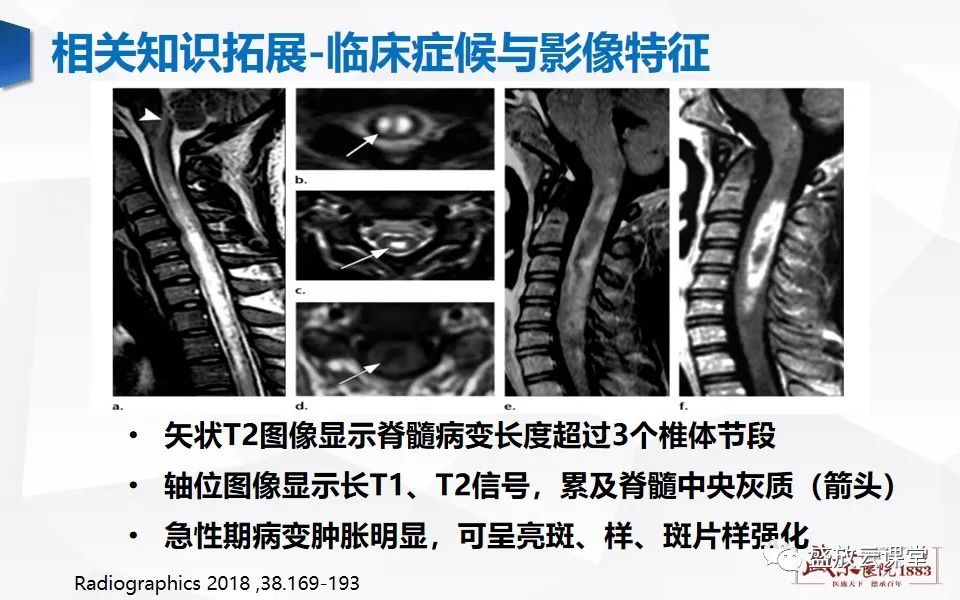 影像PPT - 【PPT】视神经脊髓炎谱系病变-25