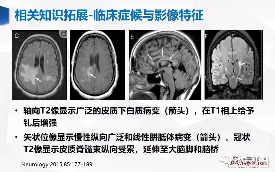 影像PPT - 【PPT】视神经脊髓炎谱系病变-33