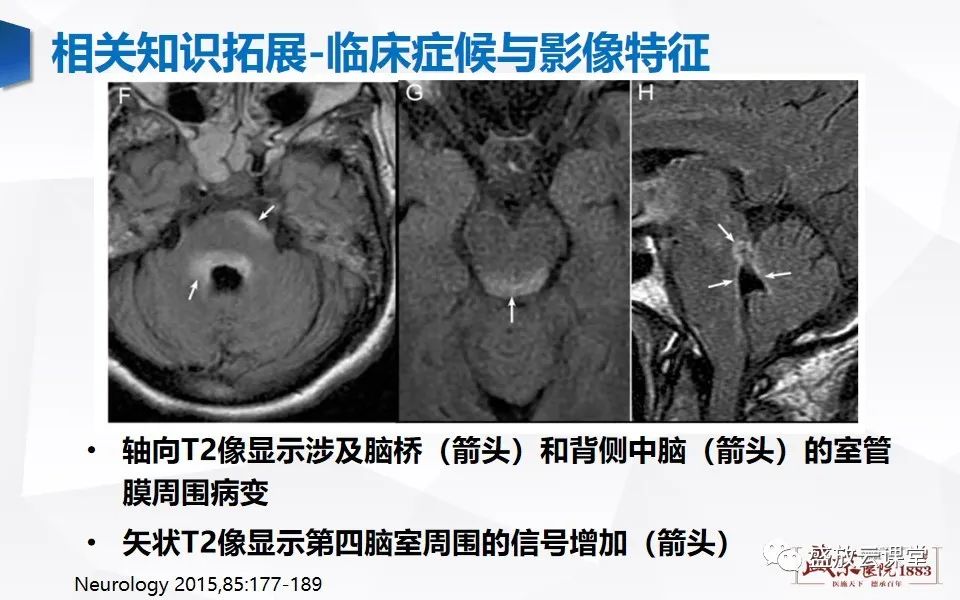 影像PPT - 【PPT】视神经脊髓炎谱系病变-29